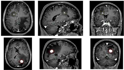 Impressive reduction of brain metastasis radionecrosis after cabozantinib therapy in metastatic renal carcinoma: A case report and review of the literature